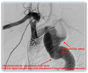 Carotid Cerebral Arteriography