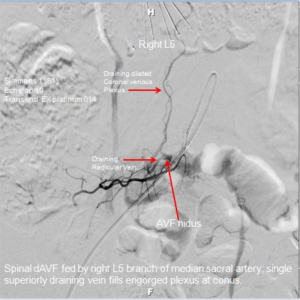 Spinal Arteriography