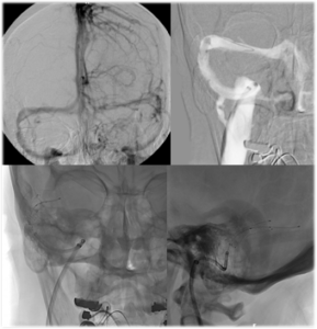 Angioplasty Stenting Dural Venous Sinus Stenosis