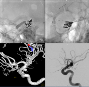 Balloon Assisted Aneurysm Coiling