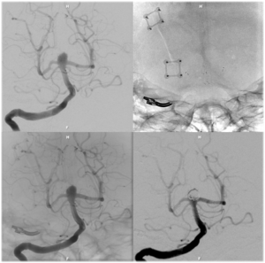 Brain Aneurysm