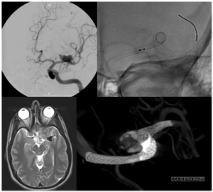 Brain Aneurysm 2