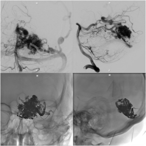 Brain Arteriovenous Malformation