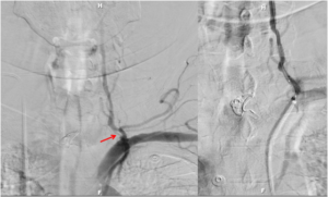 Carotid Artery Angioplasty Stenting