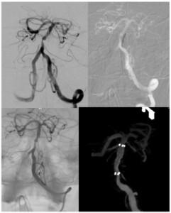 Carotid Stenosis