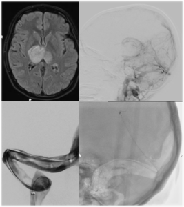 Cerebral Venous Thrombosis