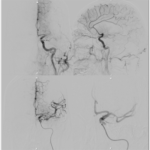 Clot Extraction Using Aspiration Systems