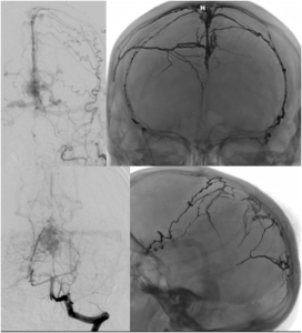 Dural Arteriovenous Fistula