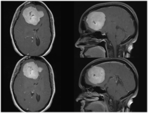 IntraArterial Chemotherapy