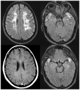 Intra arterial thrombolysis