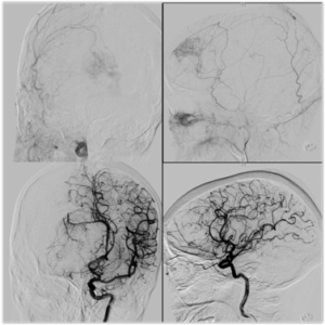 Intracrania Extracranial Tumor Embolizations