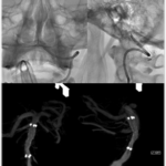 Intracranial Angioplasty and Stenting