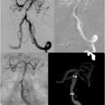 Intracranial angioplasty stenting