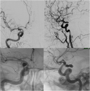 Ruptured and Unruptured Aneurysm embolization