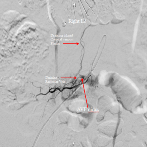 Spinal AVF Embolization