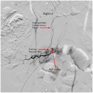 Spinal Vascular Malformation