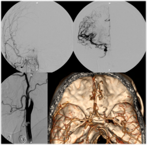 Stent Retriever Flow Restoration