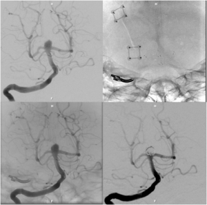 Stent assisted aneurysm coiling