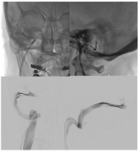 Venous Stenosis