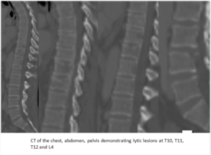 Vertebral Compression Fractures