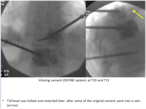 Vertebral Compression Fractures 2