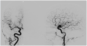 cerebral angiography